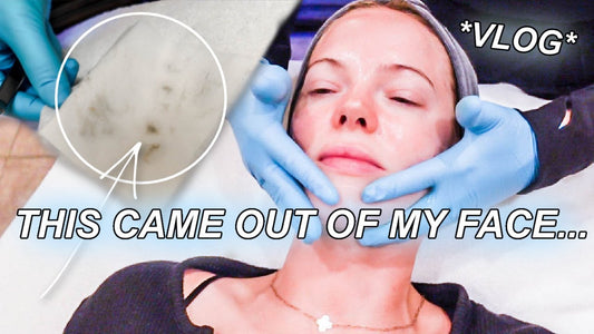 FIRST TIME GETTING EXTRACTIONS (plus dermaplaning, plus cooking gluten free) VLOG // Mallory1712